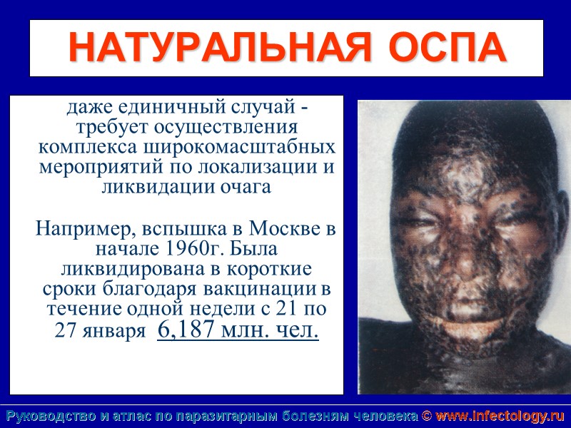 НАТУРАЛЬНАЯ ОСПА      даже единичный случай -  требует осуществления